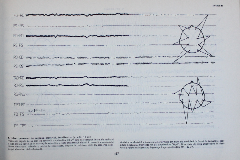 ATLAS CLINIC DE ELECTROENCEFALOGRAFIE de C. ARSENI si IGNAT ROMAN , 1986