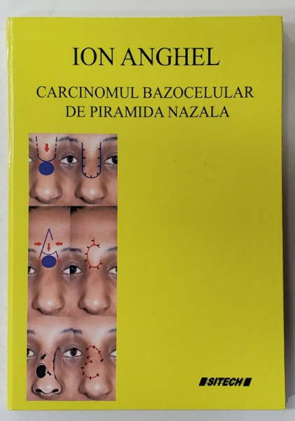 CARCINOMUL BAZOCELULAR DE PIRAMIDA NAZALA de ION ANGHEL , 2015